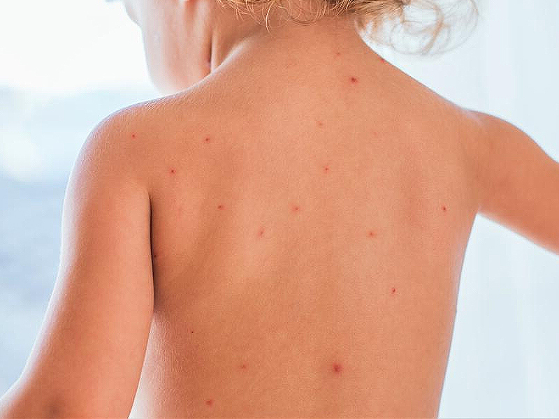 Варицела порази 146 варненци за седмица, 110 са със скарлатина