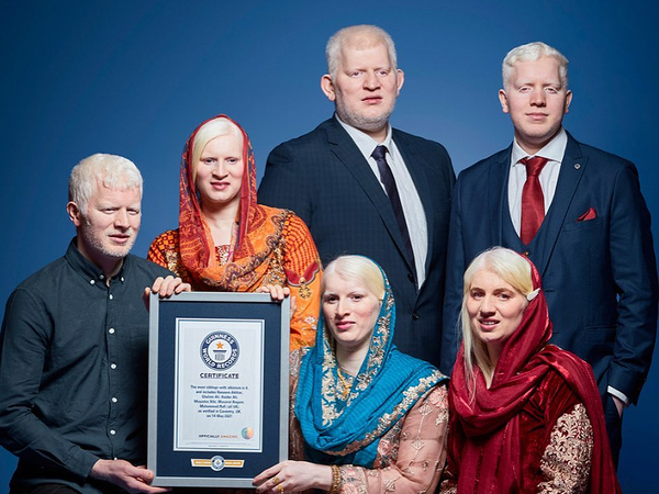 Английско семейство държи рекорда на Гинес за най-много братя и сестри с албинизъм